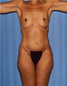 Body Contouring Before Photo by Siamak Agha, MD PhD FACS; Newport Beach, CA - Case 46679