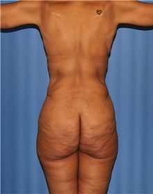 Body Contouring Before Photo by Siamak Agha, MD PhD FACS; Newport Beach, CA - Case 46679