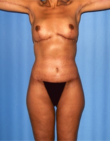 Body Lift After Photo by Siamak Agha, MD; Newport Beach, CA - Case 46680