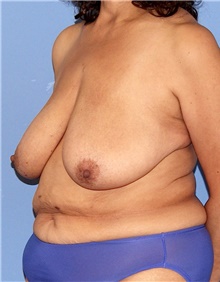 Breast Lift Before Photo by Siamak Agha, MD PhD FACS; Newport Beach, CA - Case 46682
