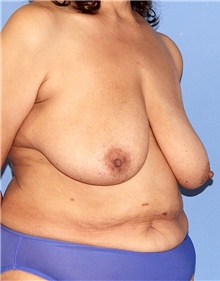 Breast Lift Before Photo by Siamak Agha, MD PhD FACS; Newport Beach, CA - Case 46682