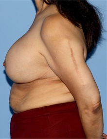 Breast Lift After Photo by Siamak Agha, MD PhD FACS; Newport Beach, CA - Case 46682