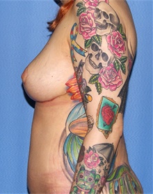 Breast Lift After Photo by Siamak Agha, MD PhD FACS; Newport Beach, CA - Case 46683