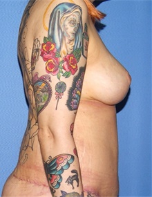 Breast Lift After Photo by Siamak Agha, MD PhD FACS; Newport Beach, CA - Case 46683
