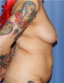 Breast Lift Before Photo by Siamak Agha, MD PhD FACS; Newport Beach, CA - Case 46683