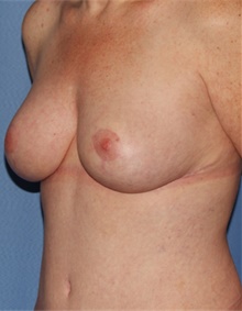 Breast Lift After Photo by Siamak Agha, MD PhD FACS; Newport Beach, CA - Case 46684