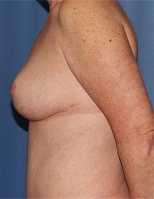 Breast Lift After Photo by Siamak Agha, MD PhD FACS; Newport Beach, CA - Case 46684