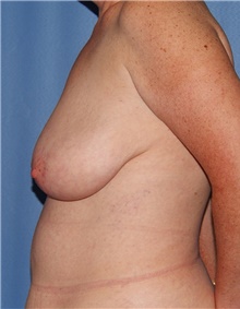 Breast Lift Before Photo by Siamak Agha, MD PhD FACS; Newport Beach, CA - Case 46684