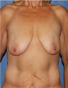 Breast Lift Before Photo by Siamak Agha, MD PhD FACS; Newport Beach, CA - Case 46686