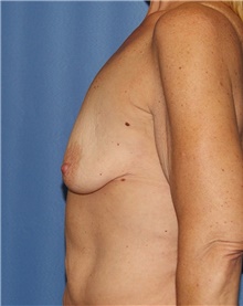 Breast Lift Before Photo by Siamak Agha, MD PhD FACS; Newport Beach, CA - Case 46686