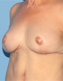 Breast Lift After Photo by Siamak Agha, MD PhD FACS; Newport Beach, CA - Case 46687