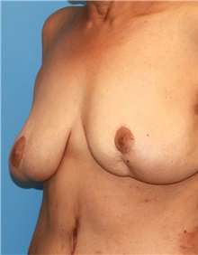 Breast Lift Before Photo by Siamak Agha, MD PhD FACS; Newport Beach, CA - Case 46687