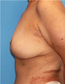 Breast Lift Before Photo by Siamak Agha, MD PhD FACS; Newport Beach, CA - Case 46687