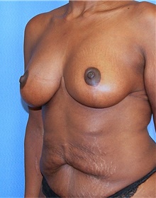 Breast Lift After Photo by Siamak Agha, MD PhD FACS; Newport Beach, CA - Case 46688