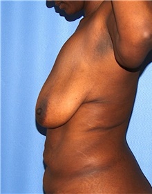 Breast Lift Before Photo by Siamak Agha, MD PhD FACS; Newport Beach, CA - Case 46688
