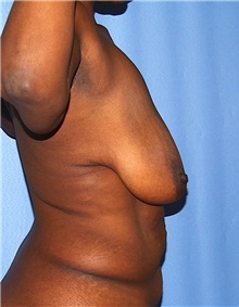 Breast Lift Before Photo by Siamak Agha, MD PhD FACS; Newport Beach, CA - Case 46688