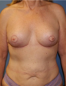 Breast Lift After Photo by Siamak Agha, MD PhD FACS; Newport Beach, CA - Case 46689