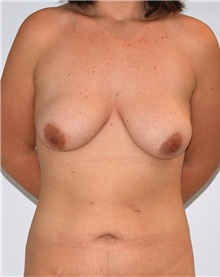Breast Lift Before Photo by Siamak Agha, MD PhD FACS; Newport Beach, CA - Case 46697