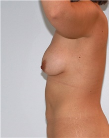 Breast Lift Before Photo by Siamak Agha, MD PhD FACS; Newport Beach, CA - Case 46697