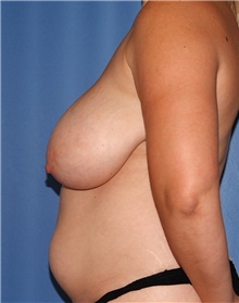 Breast Lift Before Photo by Siamak Agha, MD PhD FACS; Newport Beach, CA - Case 46698