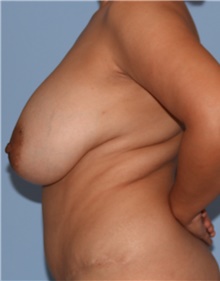 Breast Lift Before Photo by Siamak Agha, MD PhD FACS; Newport Beach, CA - Case 46700