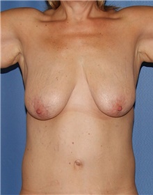 Breast Lift Before Photo by Siamak Agha, MD PhD FACS; Newport Beach, CA - Case 46702