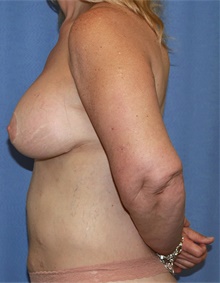 Breast Lift After Photo by Siamak Agha, MD PhD FACS; Newport Beach, CA - Case 46702
