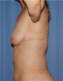 Breast Lift Before Photo by Siamak Agha, MD PhD FACS; Newport Beach, CA - Case 46702