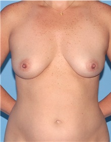 Breast Lift Before Photo by Siamak Agha, MD PhD FACS; Newport Beach, CA - Case 46703
