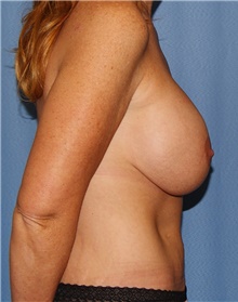 Breast Lift Before Photo by Siamak Agha, MD PhD FACS; Newport Beach, CA - Case 46704