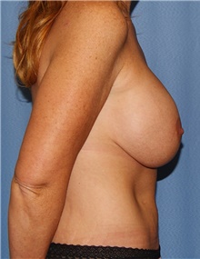 Breast Reduction Before Photo by Siamak Agha, MD PhD FACS; Newport Beach, CA - Case 46706