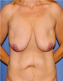 Breast Lift Before Photo by Siamak Agha, MD PhD FACS; Newport Beach, CA - Case 46707