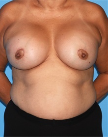 Breast Lift After Photo by Siamak Agha, MD PhD FACS; Newport Beach, CA - Case 46708