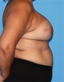 Breast Lift After Photo by Siamak Agha, MD PhD FACS; Newport Beach, CA - Case 46708