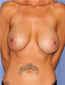 Breast Lift Before Photo by Siamak Agha, MD PhD FACS; Newport Beach, CA - Case 46709