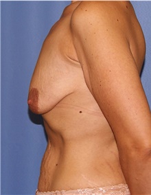 Breast Lift Before Photo by Siamak Agha, MD PhD FACS; Newport Beach, CA - Case 46710
