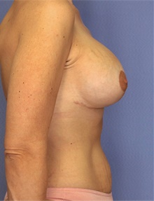 Breast Lift After Photo by Siamak Agha, MD PhD FACS; Newport Beach, CA - Case 46710