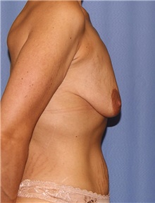 Breast Lift Before Photo by Siamak Agha, MD PhD FACS; Newport Beach, CA - Case 46710