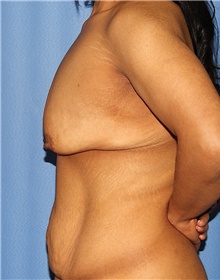 Breast Lift Before Photo by Siamak Agha, MD PhD FACS; Newport Beach, CA - Case 46711