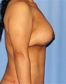 Breast Lift After Photo by Siamak Agha, MD PhD FACS; Newport Beach, CA - Case 46711