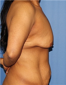 Breast Lift Before Photo by Siamak Agha, MD PhD FACS; Newport Beach, CA - Case 46711