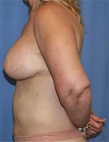 Breast Augmentation After Photo by Siamak Agha, MD PhD FACS; Newport Beach, CA - Case 46714