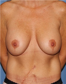 Breast Augmentation Before Photo by Siamak Agha, MD PhD FACS; Newport Beach, CA - Case 46716
