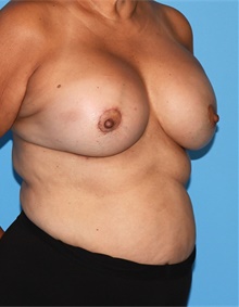 Breast Augmentation After Photo by Siamak Agha, MD PhD FACS; Newport Beach, CA - Case 46718