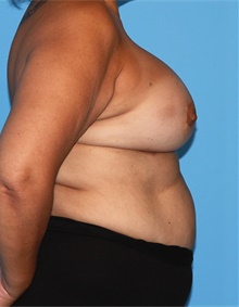 Breast Augmentation After Photo by Siamak Agha, MD PhD FACS; Newport Beach, CA - Case 46718