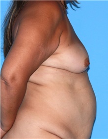Breast Augmentation Before Photo by Siamak Agha, MD PhD FACS; Newport Beach, CA - Case 46718