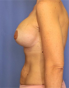 Breast Augmentation After Photo by Siamak Agha, MD PhD FACS; Newport Beach, CA - Case 46719