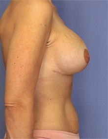 Breast Augmentation After Photo by Siamak Agha, MD PhD FACS; Newport Beach, CA - Case 46719