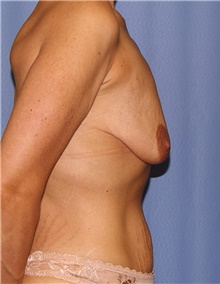 Breast Augmentation Before Photo by Siamak Agha, MD PhD FACS; Newport Beach, CA - Case 46719