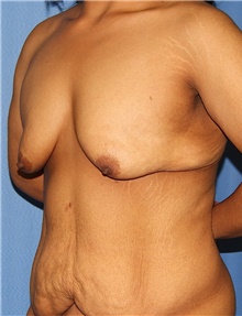 Breast Augmentation Before Photo by Siamak Agha, MD PhD FACS; Newport Beach, CA - Case 46720